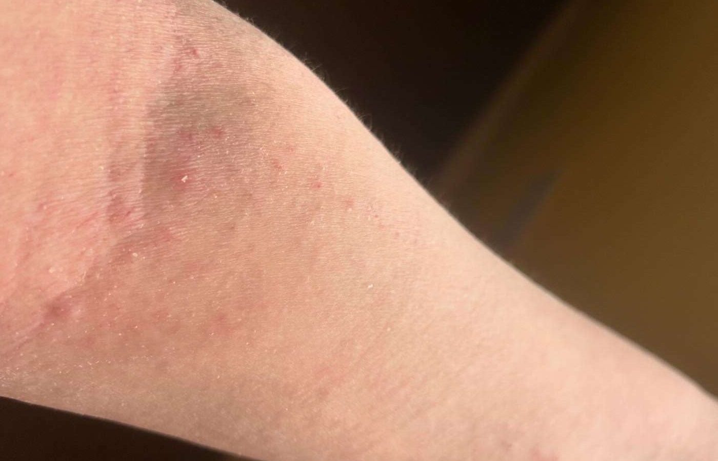 Read more about the article What is Eczema? CC’s Ultimate Guide to Itchy Skin!