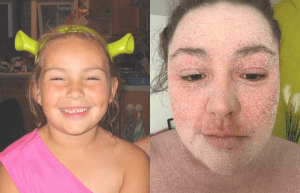 Read more about the article Living With Eczema: The Good, The Terrible And The Itchy