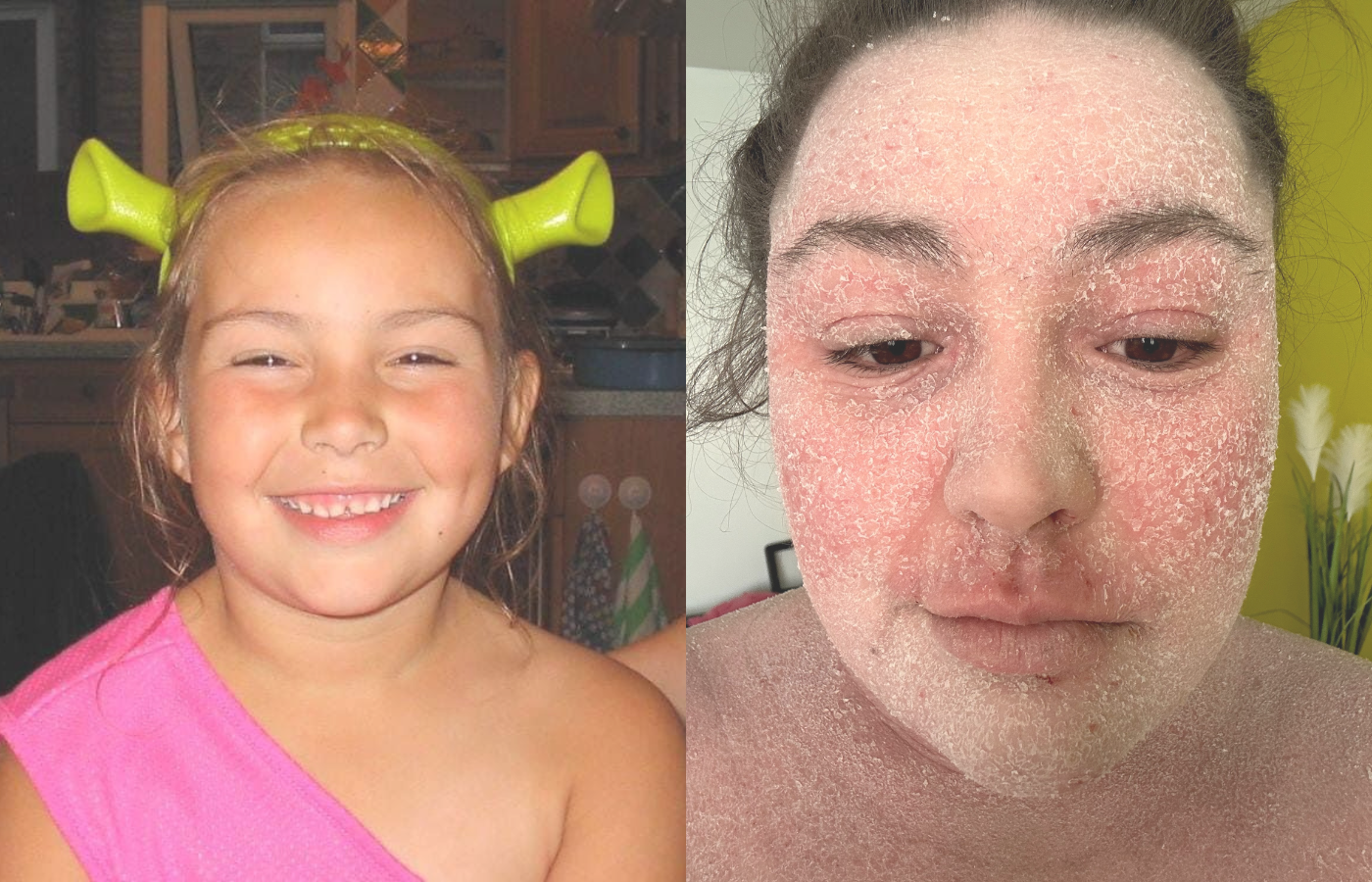 Read more about the article Living With Eczema: The Good, The Terrible And The Itchy