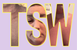 Read more about the article What is Topical Steroid Withdrawal? You Need To Know!