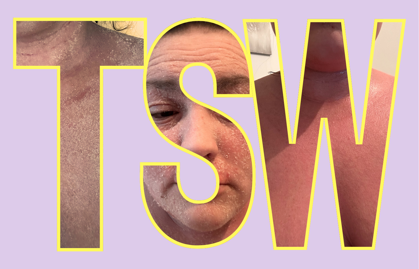 Read more about the article What is Topical Steroid Withdrawal? You Need To Know!