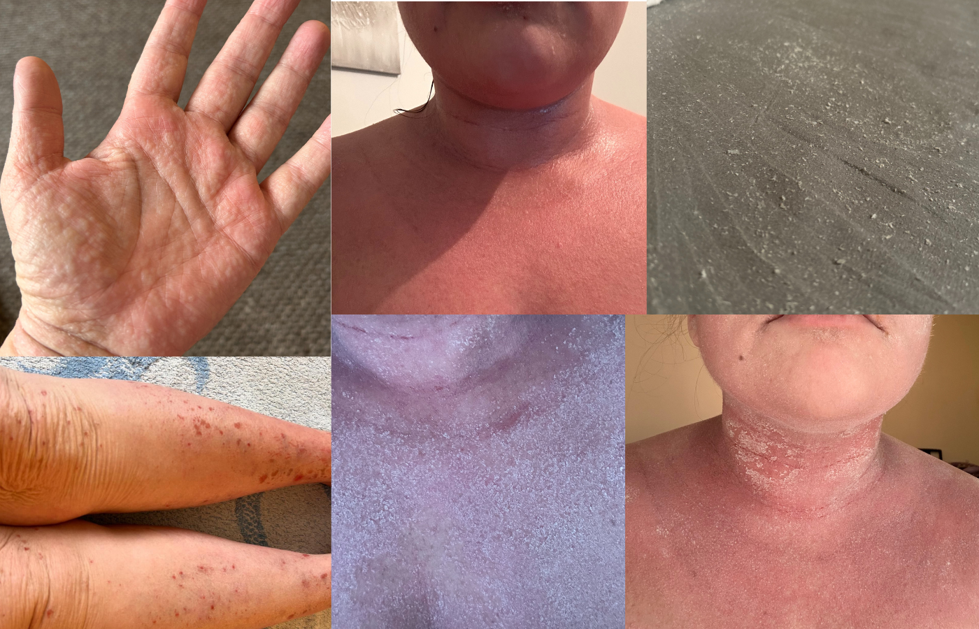 Read more about the article The 10 Best Things About Living With Eczema!